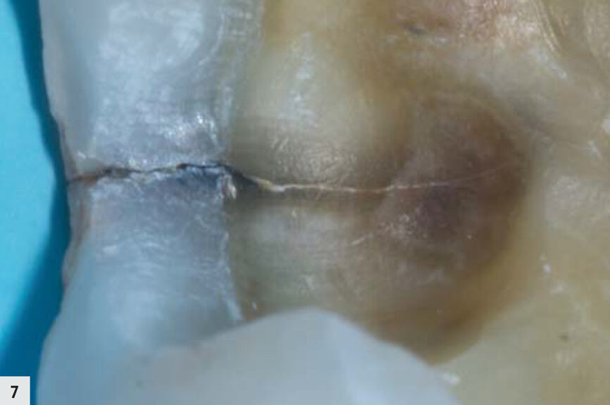 Figs. 6–7 : Fissure dans la boîte proximale, devenue plus apparente après l’élimination de la boue dentinaire. 
