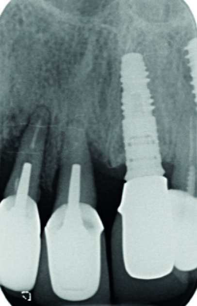 Fig. 3 : Radiographie long cône du secteur à implanter. Notez l’absence d’infection et la bonne intégration de l’implant en 21, posé en 2008. 