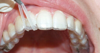 Stop asking aligners to do things they are not good at!