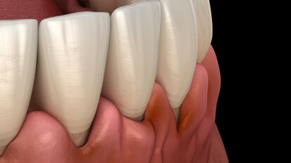 Parodontitis erhöht Krebsrisiko um bis zu 50 Prozent