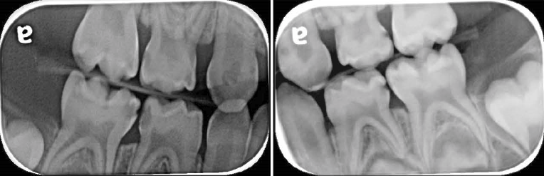 Figures 2 (a & b): Bitewing radiographs showing caries on all Ds and Es. There were clear bands of dentine between the carious lesions and the pulp. There were no radiographic signs of interradicular pathology. Although the furcation areas of upper Es were not visible, no further xrays were justified as the upper Es had shallow radiographic lesions.