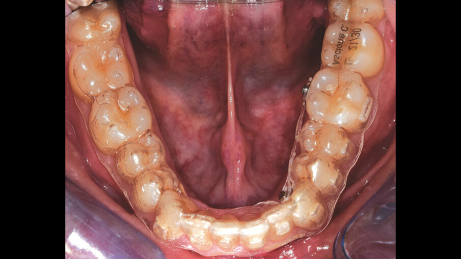 Figg. 1a, 1b_Utilizzo di dispositivi ausiliari (REP su miniviti nella foto a sinistra e bottoni linguali con trazione elastica nella foto di destra) per aumentare la predicibilità dei trattamenti con allineatori dentali ALLEO.