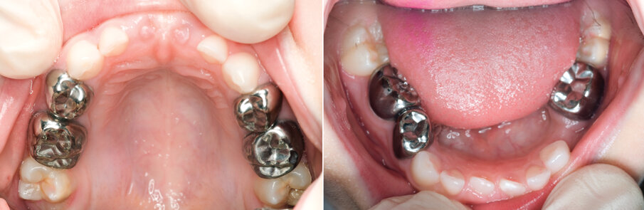 Figure 10 (a&b). A patient treated by the author received 7 SSCs using the hall technique. No LA, rubber dam, caries removal or drills were used. They remained free from clinical and radiographic signs and symptoms of pain or sepsis. Compare these with figures 3 (c & d) . Tooth 74 was extracted as it was not restorable.