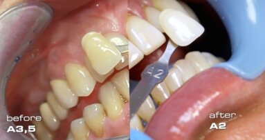 Wybielanie zębów z nadwrażliwością zębiny laserem diodowym