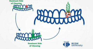 I cambiamenti nella masticazione sono una delle ragioni del deterioramento degli impianti dentali