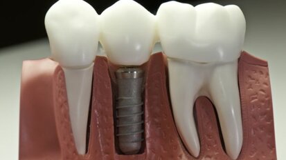 Kostenbesparing en toenemende toegang tot orale implantaten