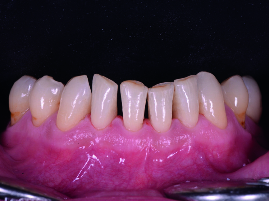 Fig. 18 : Vue préopératoire des dents antérieures inférieures. 
