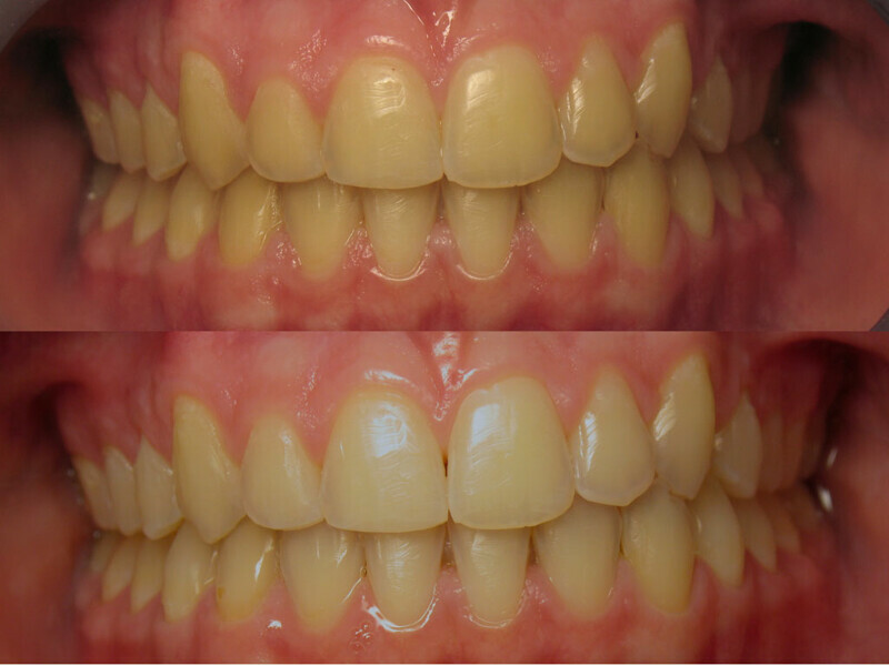 Figura 10. Caso clínico antes y después de un blanqueamiento dental con cubetas listas para usar.
