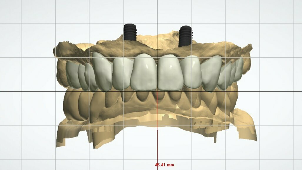 Piano di trattamento clinico con utilizzo di progetto digitale complesso su edentulie estese di entrambe le arcate dentarie