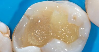 Continued education: Cavity restoration with fibre reinforced composites