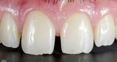 Extremely minimally invasive mock-up-guided veneer preparations in the aesthetic area