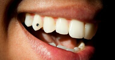 Tandarts waarschuwt voor gevaren tandjuwelen