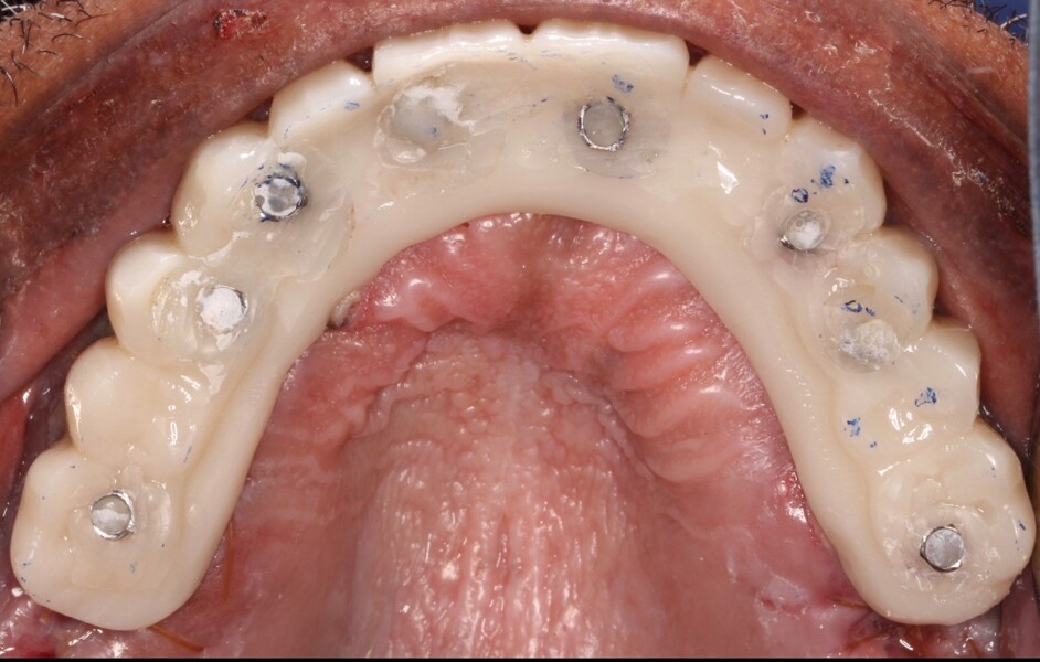 Fig. 18: Occlusal view of the maxillary Flexcera Smile prosthesis.