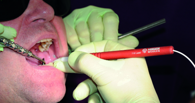 Diode laser application optimises the clinical outcomes of digital workflow