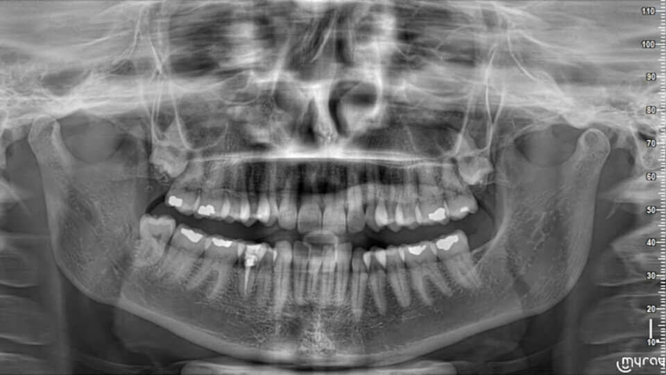 External cervical root resorption