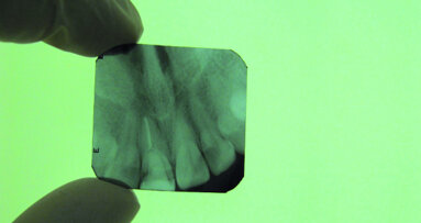Ostéo-intégration assistée par laser : une diode laser pour la pose d’un implant de type I