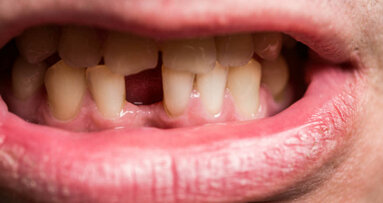 Zaprzestanie palenia może zmniejszyć ryzyko utraty zębów