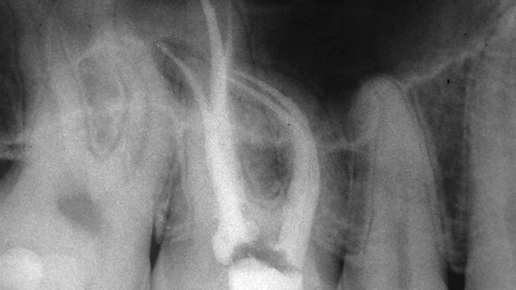The real state of endodontic instrumentation