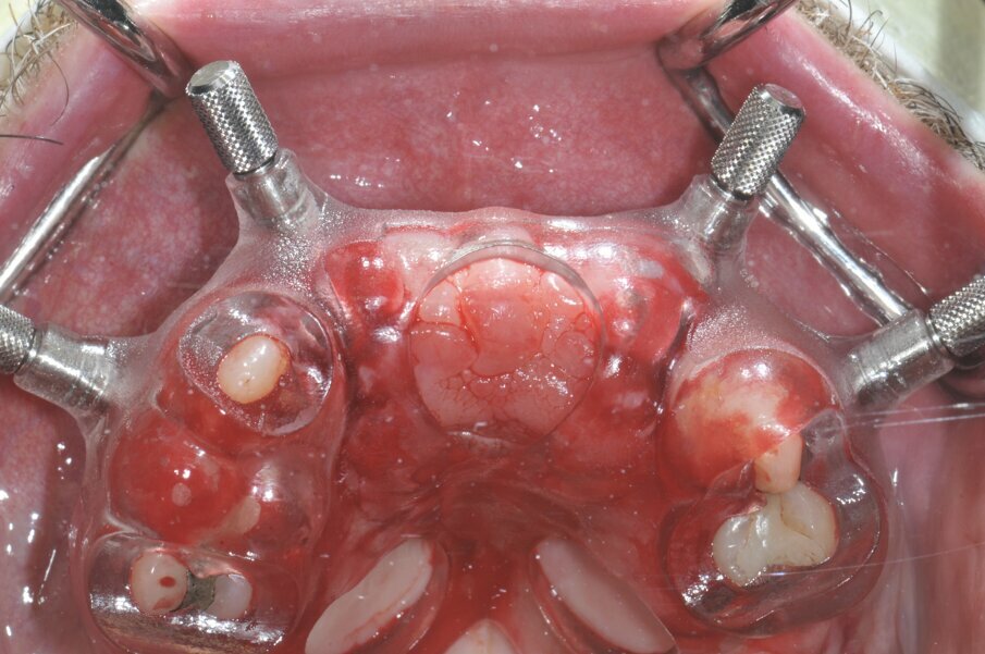 Fig. 3a_Dima chirurgica ad appoggio dentale e mucoso per il posizionamento dei pin di posizione.