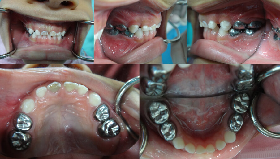 Figures 4 (a, b, c, d & e): 9 months post- treatment. The patient had no complaints. The occlusion had equilibrated (note primary canines in Figures 4 b & c and compare to Figure 3 a, d & e). All Es and Ds remained asymptomatic. Good gingival health and oral hygiene were noted.  As his cooperation improved plans are in place to monitor 51 with a view to carry out pulp therapy in addition to restoring upper anteriors with composite strip crowns.