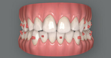Traitement orthodontique par aligneurs transparents d’une malocclusion complexe