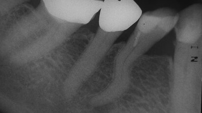 Racine en S – risques relevant d’un défi majeur en endodontie