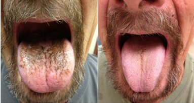 Antibiotics could cause black hairy tongue