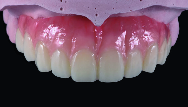 Fig 18. Ceramage GUM translucent (GUM-T) was applied to reproduce of reddish translucent gingiva areas.