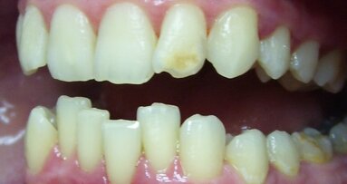 Réadaptation esthétique de dents antérieures hypoplasiques en  utilisant le Laser LiteTouch Er:YAG. Un rapport de cas.