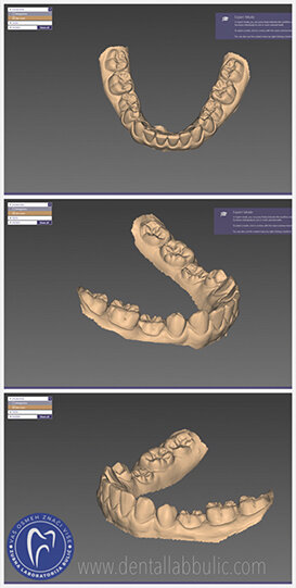 Slika 4: slučaj anodoncije drugih premolara u donjoj vilici, obostrano. Izgled intra oralnog skena u exoced-ovom dental CAD programu ; Ordinacija Veljkov, dr Dejan Veljkov