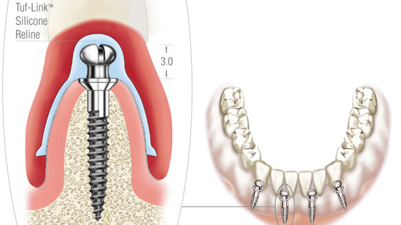 The Atlas Denture Comfort System