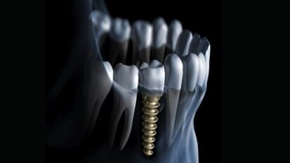Secrets of successful dental implant placements