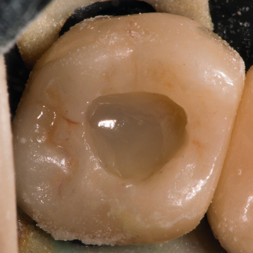 Fig. 13 : everX Flow, teinte dentine. 