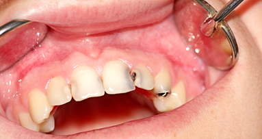 Grundlegende Empfehlungen zur Kariesprophylaxe bei bleibenden Zähnen
