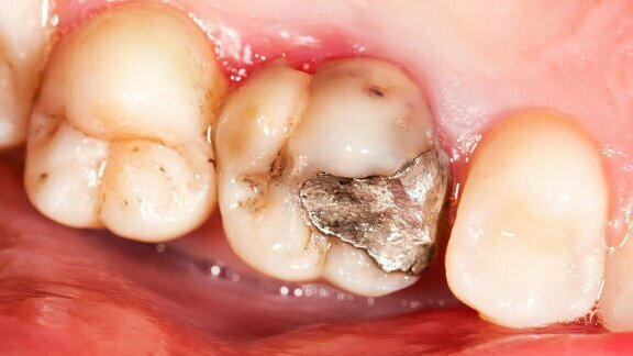 לאמלגם אין מקום ברפואת שיניים קלינית