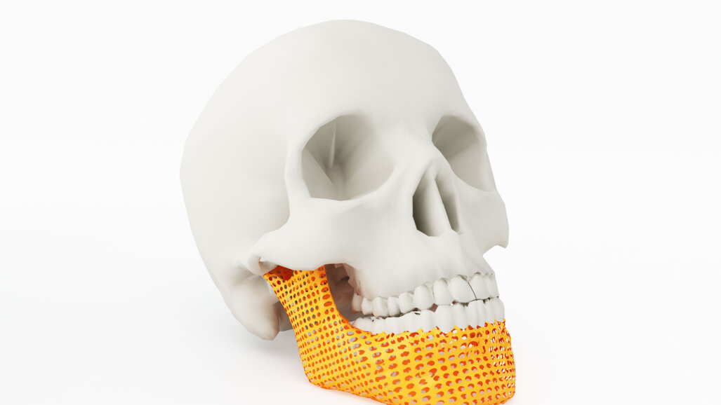 La stampa 3D in chirurgia orale e maxillo-facciale