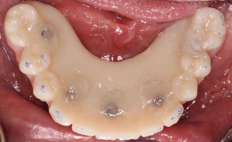 Fig. 19: Occlusal view of the mandibular Flexcera Smile prosthesis.