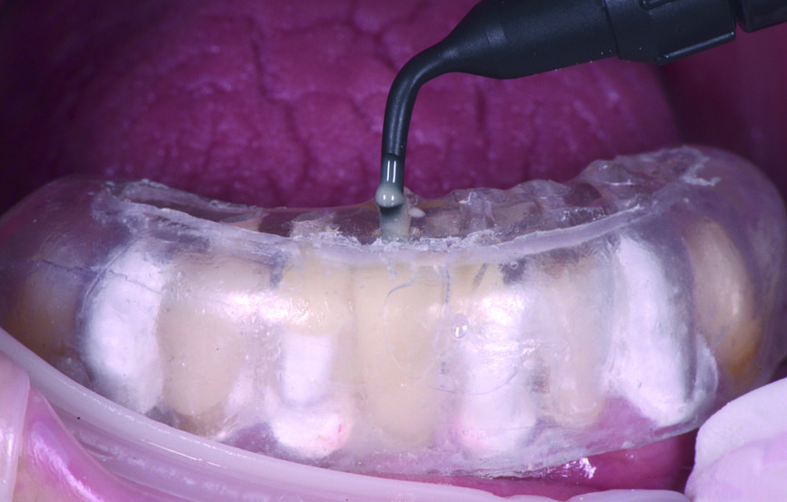 Fig. 19 : Restauration des dents antérieures inférieures par la technique d’injection de composite (G-ænial Universal Flo). 