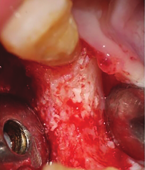 Figure 9: 5 months postoperative intraoral view showing substantial vertical and horizontal bone augmentation.