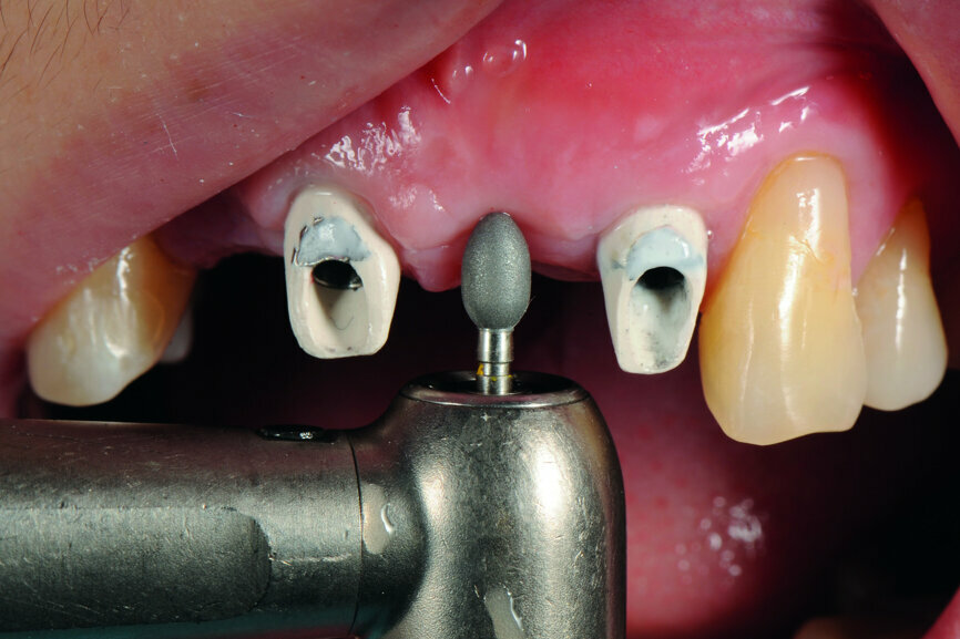 Fig. 16: Modification of the gingival contour under the pontic.