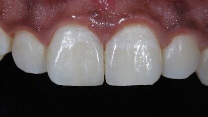 Direct composite restorations in maxillary central incisors with unequal mesio-distal width.