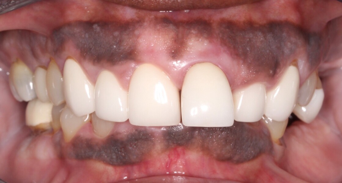 Fig. 8: Frontal view of the teeth in maximum intercuspation.
