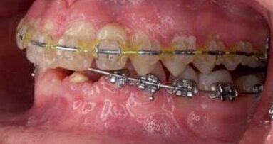 Rehabilitacja przypadku hipodoncji i mikrodoncji poprzez skojarzone leczenie ortodontyczne i implantoprotetyczne