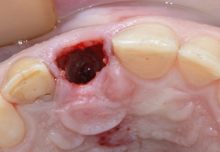 Fig. 11: Clean socket after atraumatic extraction of tooth #11.