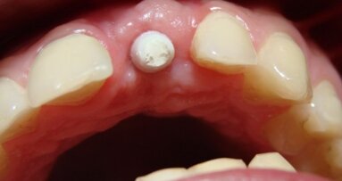 Implantoprotetyczne odtworzenie brakującego zęba 21 – opis przypadku
