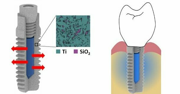 New implant releases antimicrobial drugs to fight infections