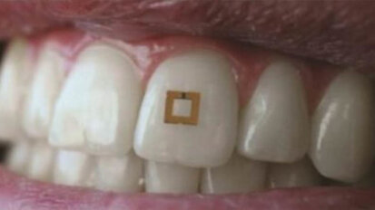 Novo dente montado em microchip rastreia alimentos ingeridos
