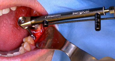 Straumann BLX implant: First human case study yields positive results for molar replacement
