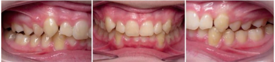 6 month progress records (weekly aligner changes) – Class I molar and canine relationship was achieved, but the transverse and posterior vertical dimensions still needed correction.