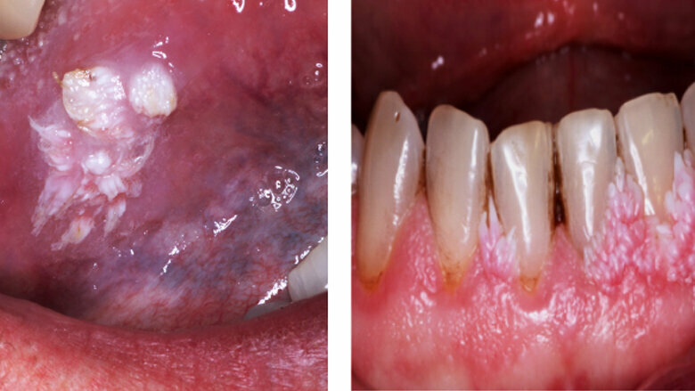 Fig. 2. Verrugas. Lesión benigna que se localiza frecuentemente en lengua, paladar duro, paladar blando y labio, frecuente en niños y adolescentes.